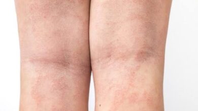 آلرژی به کلر استخر شنا چیست و با چه علائمی شناخته می شود؟